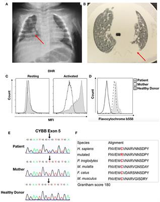 A C126R de novo Mutation in CYBB Leads to X-linked Chronic Granulomatous Disease With Recurrent Pneumonia and BCGitis